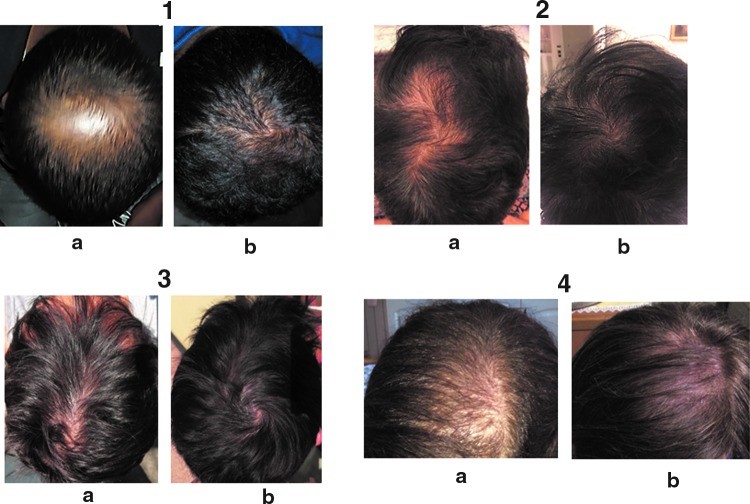 Mela annurca e ricrescita dei capelli prima e dopo